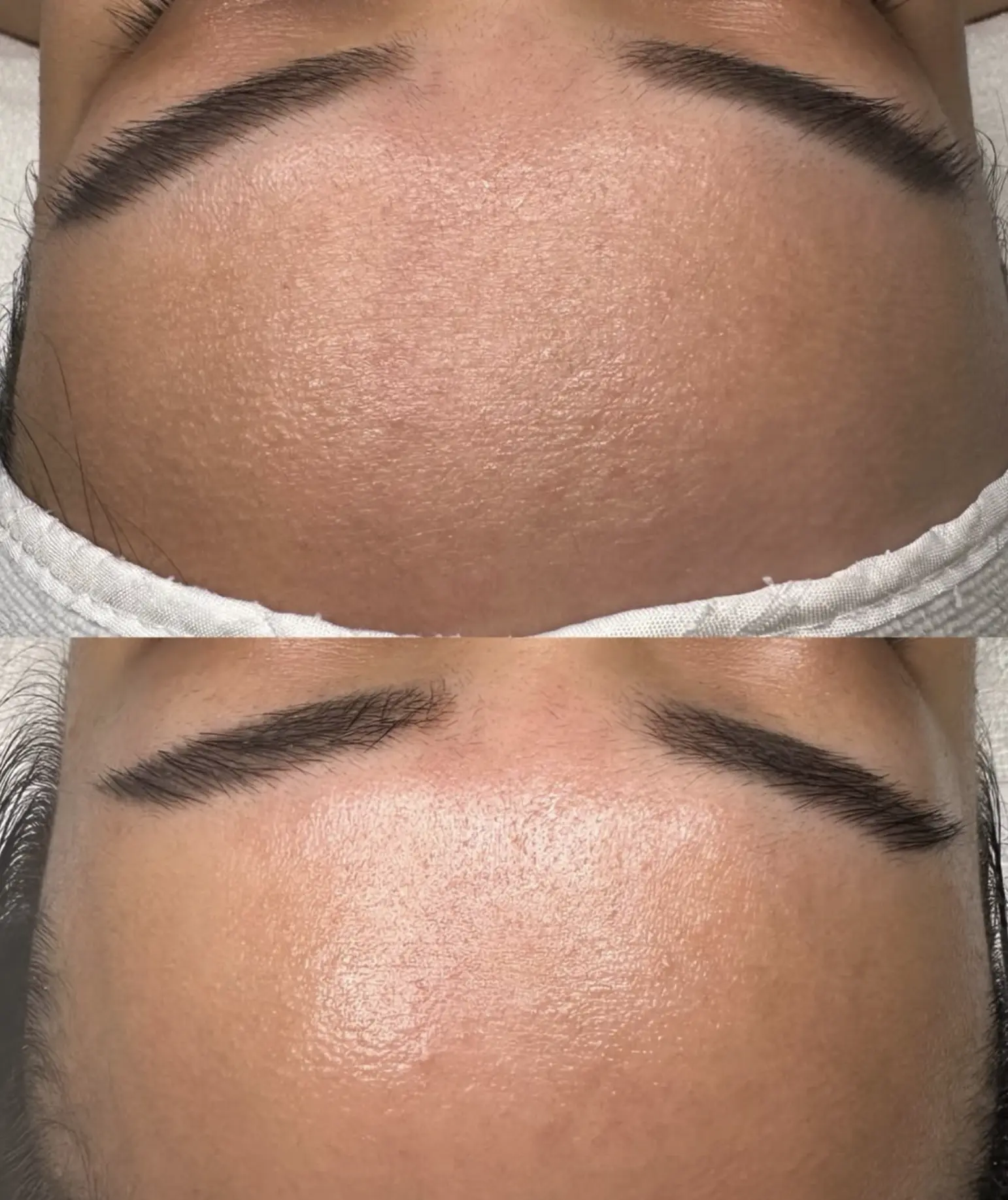 hydrafacial brisbane